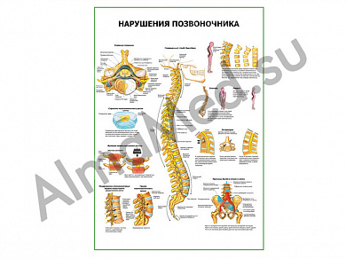 Нарушения позвоночника плакат ламинированный А1/А2 (ламинированный A2)