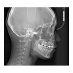 RAYSCAN Symphony Alpha SC - ортопантомограф с цефалостатом, 26х24 см