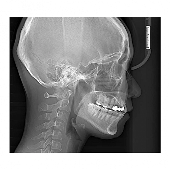 RAYSCAN Symphony Alpha SC - ортопантомограф с цефалостатом, 26х24 см