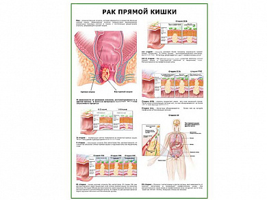 Рак прямой кишки плакат глянцевый  А1/А2 (глянцевый A1)