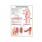Полипы кишечника плакат глянцевый А1/А2 (глянцевый A2)
