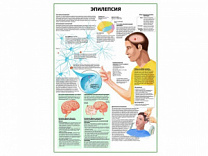 Эпилепсия плакат глянцевый А1/А2 (глянцевый A2)