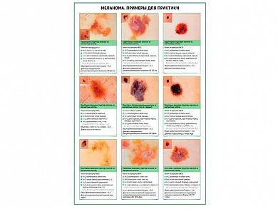 Меланома, примеры для практики, плакат глянцевый А1/А2 (глянцевый A2)
