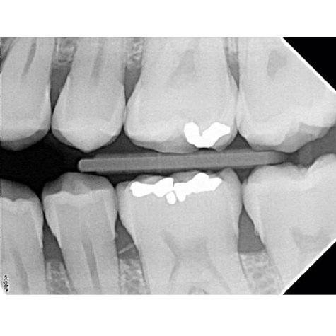Satelec X-Mind DC Mobile - высокочастотный мобильный дентальный рентгеновский аппарат (Франция)