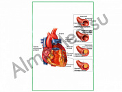 Развитие атеросклероза, плакат ламинированный А1/А2 (ламинированный A2)
