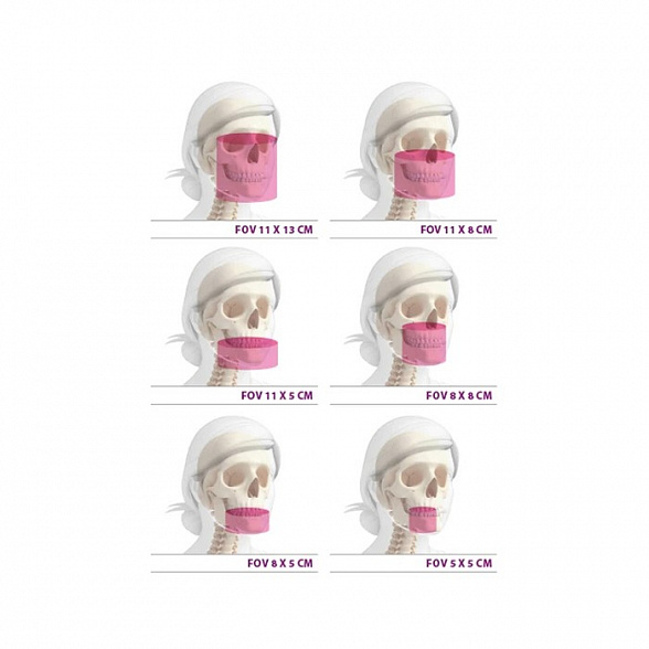 Hyperion X9 Pro 11x13 Ceph Titanium - дентальный цифровой 3D-томограф с цефалостатом, 3 в 1, FOV 11x13