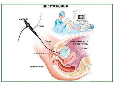 Цистоскопия, плакат глянцевый А1/А2 (глянцевый A2)