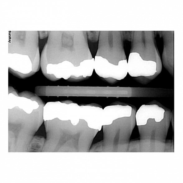 SuniRay2 - система компьютерной радиовизиографии, размер 2