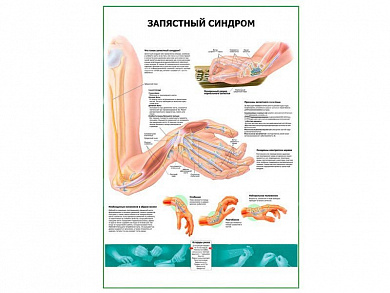 Запястный синдром плакат глянцевый А1/А2 (глянцевый A2)