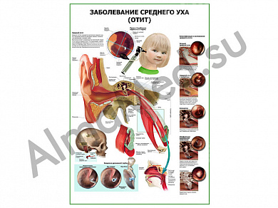 Заболевания среднего уха (отит) плакат глянцевый/ламинированный А1/А2 (глянцевый A2)