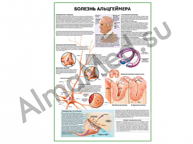 Болезнь Альцгеймера плакат ламинированный А1/А2 (ламинированный A2)