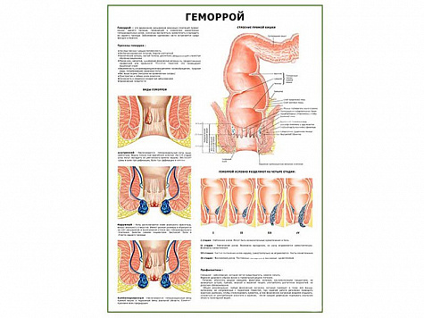 Геморрой плакат глянцевый А1/А2 (глянцевый A1)