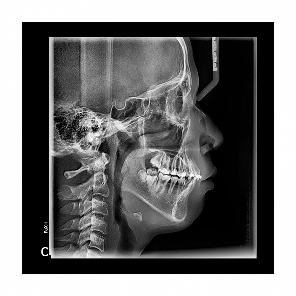 Pax-i 3D - панорамный аппарат и конусно-лучевой томограф, FOV 17x15 см | Vatech