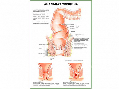 Анальная Трещина плакат глянцевый  А1/А2 (глянцевый A2)