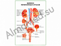 Болезни мочеполовых органов плакат ламинированный А1/А2 (ламинированный A2)