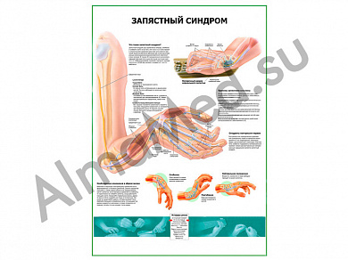 Запястный синдром плакат ламинированный А1/А2 (ламинированный A2)