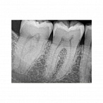 Carestream Dental RVG 6200 - радиовизиограф, 24 пар линий/мм
