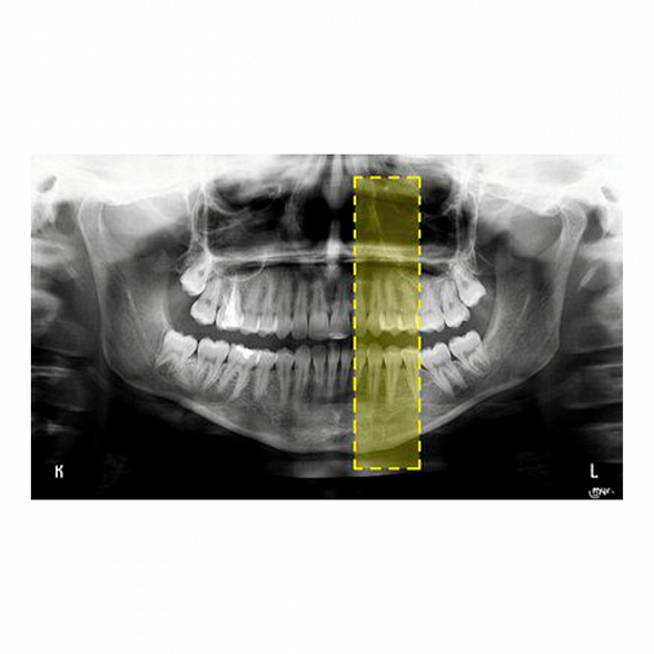 MyRay Hyperion X9 CB3D 11x13 Ceph Titanium - дентальный цифровой 3D-томограф с цефалостатом, 3 в 1, FOV 11x13