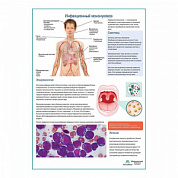 Инфекционный мононуклеоз медицинский плакат А1+/A2+ (матовый холст от 200 г/кв.м, размер A1+)