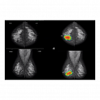 AI-платформа для анализа маммограмм ТриоДМ-МТ