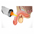 Аппарат ударно-волновой терапии Duolith SD1 T-Top (Ultra)