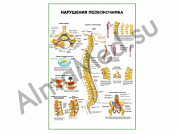 Нарушения позвоночника плакат глянцевый/ламинированный А1/А2 (глянцевый A2)
