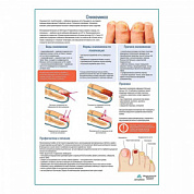 Онихомикоз медицинский плакат А1+/A2+ (глянцевый холст от 200 г/кв.м, размер A1+)