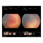 Педиатрическая ретинальная камера RetCam 3