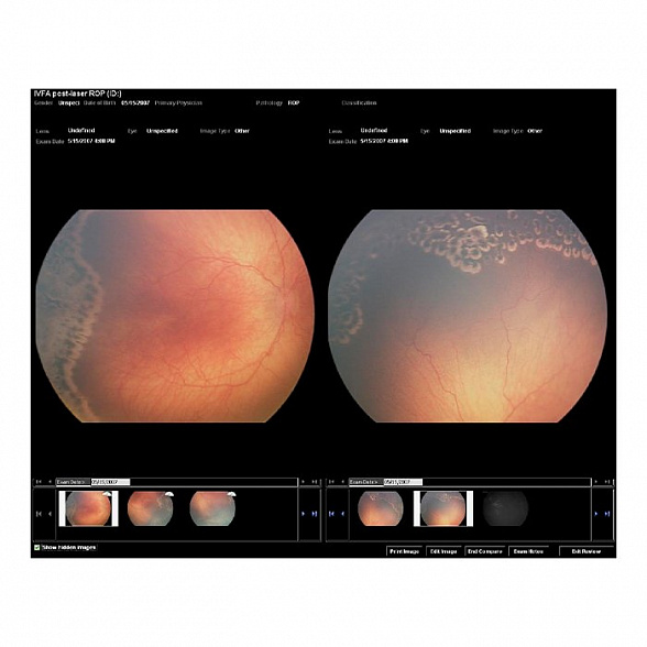 Педиатрическая ретинальная камера RetCam 3