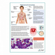 Инфекционный мононуклеоз медицинский плакат А1+/A2+ (глянцевый холст от 200 г/кв.м, размер A1+)