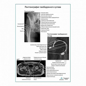 Рентгенография тазобедренного сустава плакат глянцевый А1+/А2+ (матовый холст от 200 г/кв.м, размер A1+)
