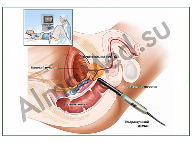 УЗИ предстательной железы, плакат ламинированный А1/А2 (ламинированный	A2)
