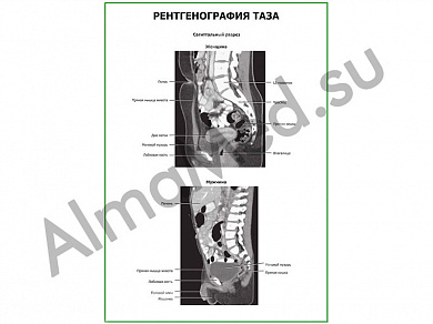 Рентгенография таза плакат глянцевый/ламинированный А1/А2 (глянцевый	A2)