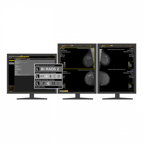 AI-платформа для анализа маммограмм ТриоДМ-МТ