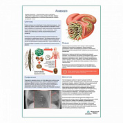 Аскаридоз медицинский плакат А1+/A2+ (глянцевый холст от 200 г/кв.м, размер A1+)