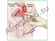 Пальпация предстательной железы, плакат ламинированный А1/А2 (ламинированный	A2)