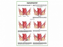 Парапроктит плакат глянцевый А1/А2 (глянцевый A2)