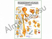 Воспалительные нарушения тазобедренного и коленного суставов плакат глянцевый/ламинированный А1/А2 (глянцевый A2)