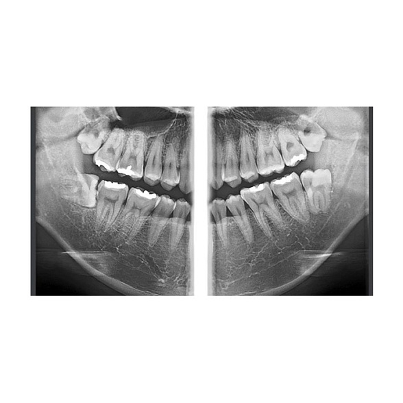 RAYSCAN Symphony Alpha Plus 120 M3DL - ортопантомограф с цефалостатом (OneShot) 33х33 см и компьютерным томографом 3D (4х12)*(3х10) см