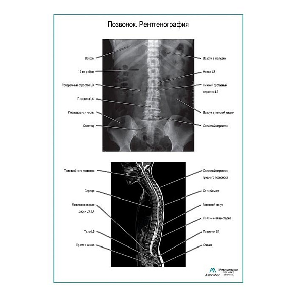 Позвонок. Рентгенография плакат глянцевый  А1+/А2+ (глянцевая фотобумага от 200 г/кв.м, размер A2+)