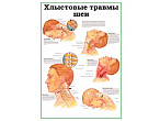 OLD Хлыстовые травмы шеи, плакат глянцевый  А1/А2 (глянцевый A2)