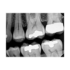 Carestream Dental RVG 6200 - радиовизиограф, 24 пар линий/мм