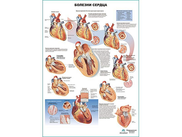 OLD Болезни сердца, плакат глянцевый А1/А2 (глянцевый холст от 200 г/кв.м, размер A1+)