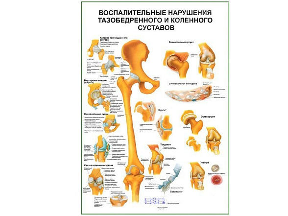 OLD Воспалительные нарушения тазобедренного и коленного суставов плакат глянцевый А1/А2 (глянцевый A2)
