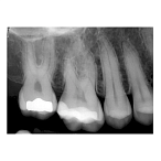SuniRay2 - система компьютерной радиовизиографии, размер 2