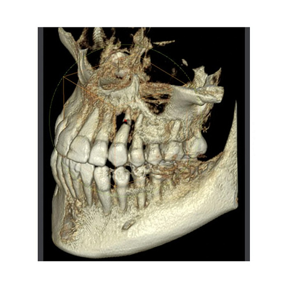 RAYSCAN Symphony Alpha 3D - ортопантомограф с компьютерным томографом, 3D 9х9 см