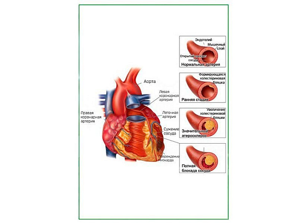 OLD Развитие атеросклероза, плакат глянцевый А1/А2 (глянцевый A1)
