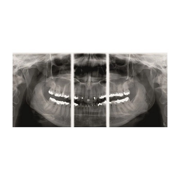 KaVo Pan eXam Plus 3D Ceph (2 датчика) - универсальный датчик Pan/Ceph для панорамной томографии, цефалостат, функция 3D-томографии 6x8 см