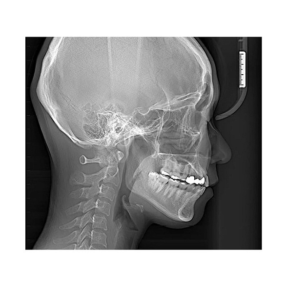 RAYSCAN Symphony Alpha Plus 120 (3D) - ортопантомограф с компьютерным томографом, 3D (4х12)*(3х10) см