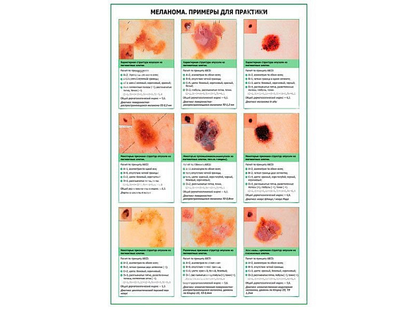 OLD Меланома, примеры для практики, плакат глянцевый А1/А2 (глянцевый A2)